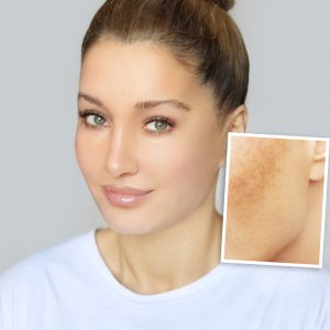 Trattamenti Medicina Estetica Rimuovere Macchie Solari Lentigo Padova