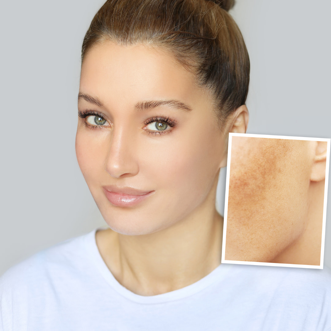 Trattamenti Medicina Estetica Rimuovere Macchie Solari Lentigo Padova Trattamenti Medicina Estetica Rimuovere Macchie Solari Lentigo Padova