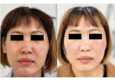 Trattamento acne in Medicina Estetica a Padova