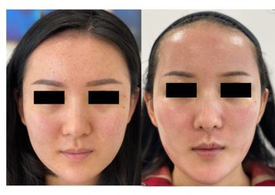 Trattamento acne Padova