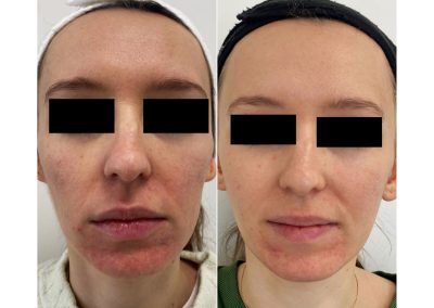 Trattamento dell'acne Padova