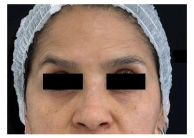 Botulino post trattamento