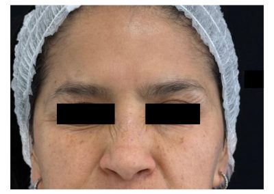 Botulino post trattamento