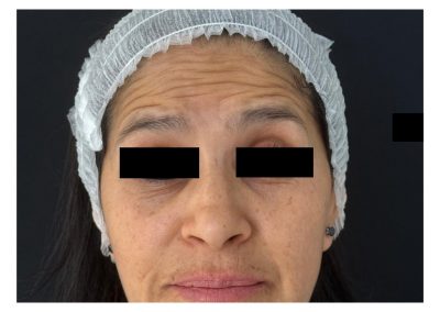 Botulino prima del trattamento