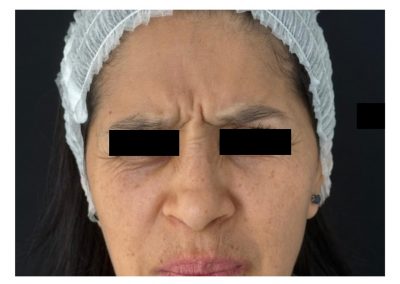 Botulino prima del trattamento