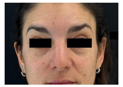 Botulino post trattamento