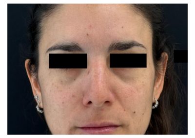 Botulino post trattamento