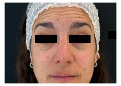 Botulino prima del trattamento