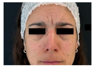 Botulino prima del trattamento