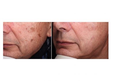 Trattamento laser per Cheratosi