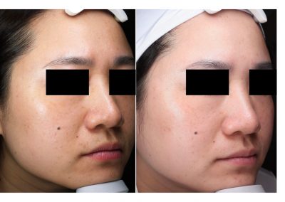 Trattamento macchie viso a Padova