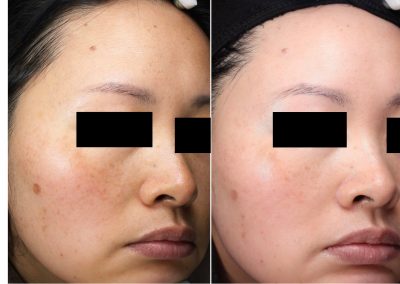 Trattamento macchie viso a Padova