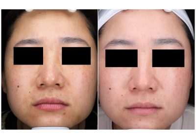 Trattamento macchie viso a Padova