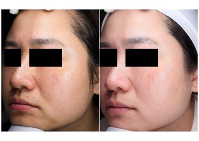 Trattamento macchie viso a Padova