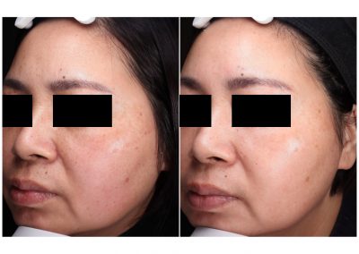 Trattamento macchie viso a Padova