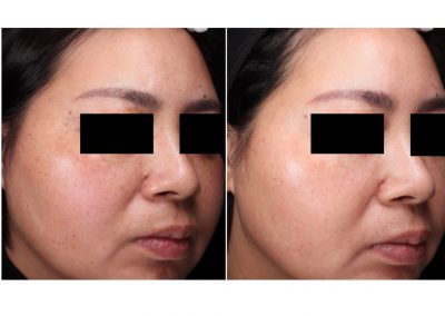 Trattamento macchie viso a Padova