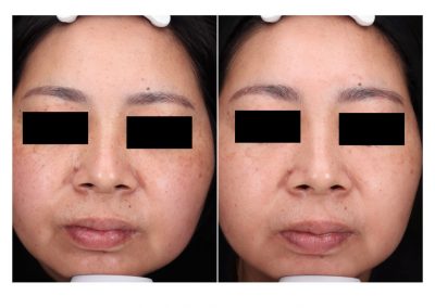 Trattamento macchie viso a Padova