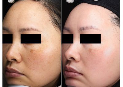 Trattamento macchie viso a Padova