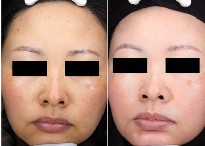 Trattamento macchie viso a Padova