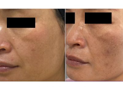 Trattamento Melasma