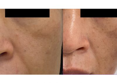 Trattamento Melasma