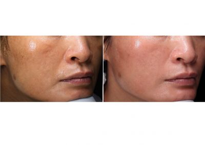 Trattamento melasma a Padova
