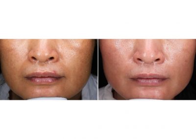 Trattamento melasma a Padova