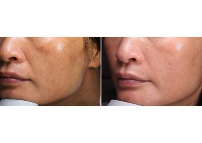 Trattamento melasma a Padova