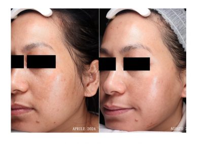 Trattamento Melasma Confronto