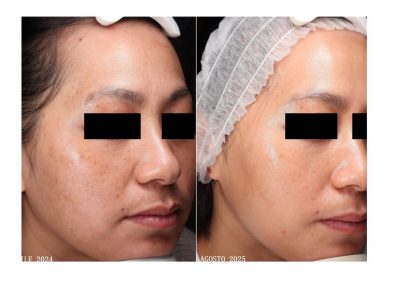 Trattamento Melasma Confronto