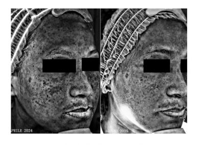 Trattamento Melasma Confronto