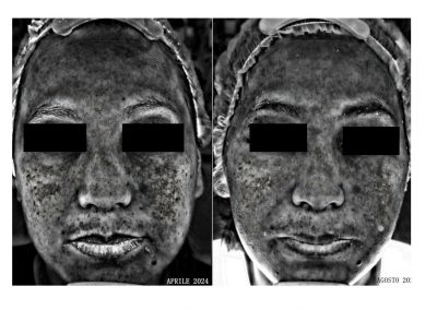 Trattamento Melasma Confronto