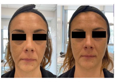 Trattamento Occhiaie