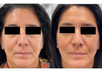 Trattamento Occhiaie