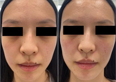 Trattamento Occhiaie