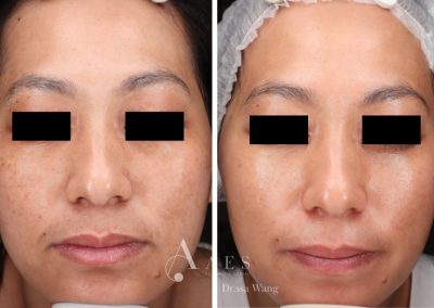 Trattamento Prima Dopo MELASMA