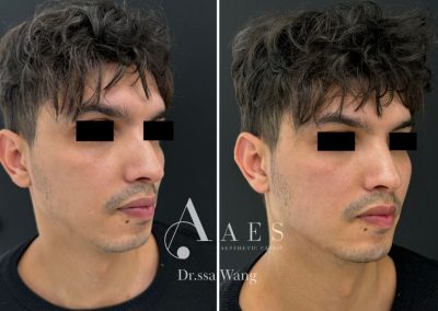 Trattamento Prima Dopo RIDEFINIZIONE PROFILO MANDIBOLARE