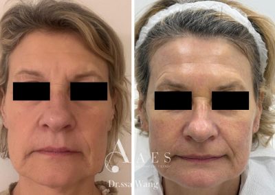 Trattamento Prima Dopo RINGIOVANIMENTO FULL FACE