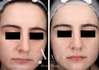 Trattamento Prima Dopo Acne Laserterapia