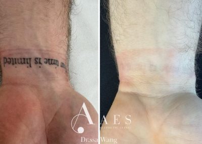 Trattamento Prima Dopo Rimozione Tatuaggio 16 04 2026 1