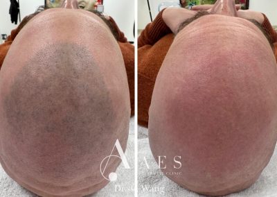 Trattamento Prima Dopo Rimozione Tatuaggio