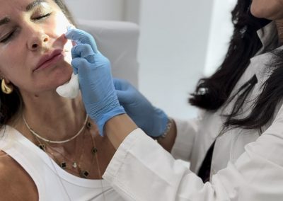 Trattamento Radiesse® Padova