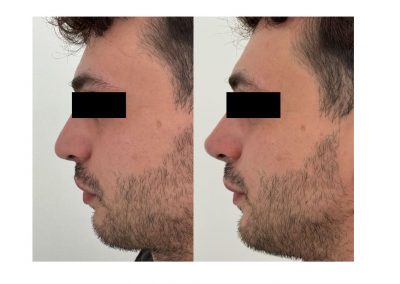 Trattamento Rinofiller e Profilo Mento