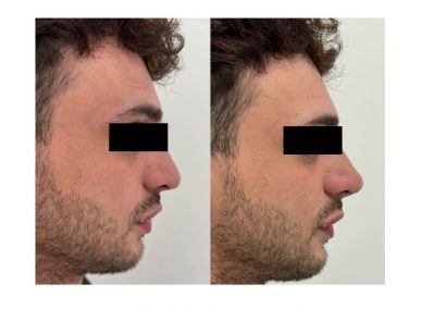 Trattamento Rinofiller e Profilo Mento